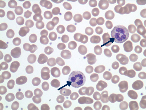 Normal peripheral blood with two neutrophils