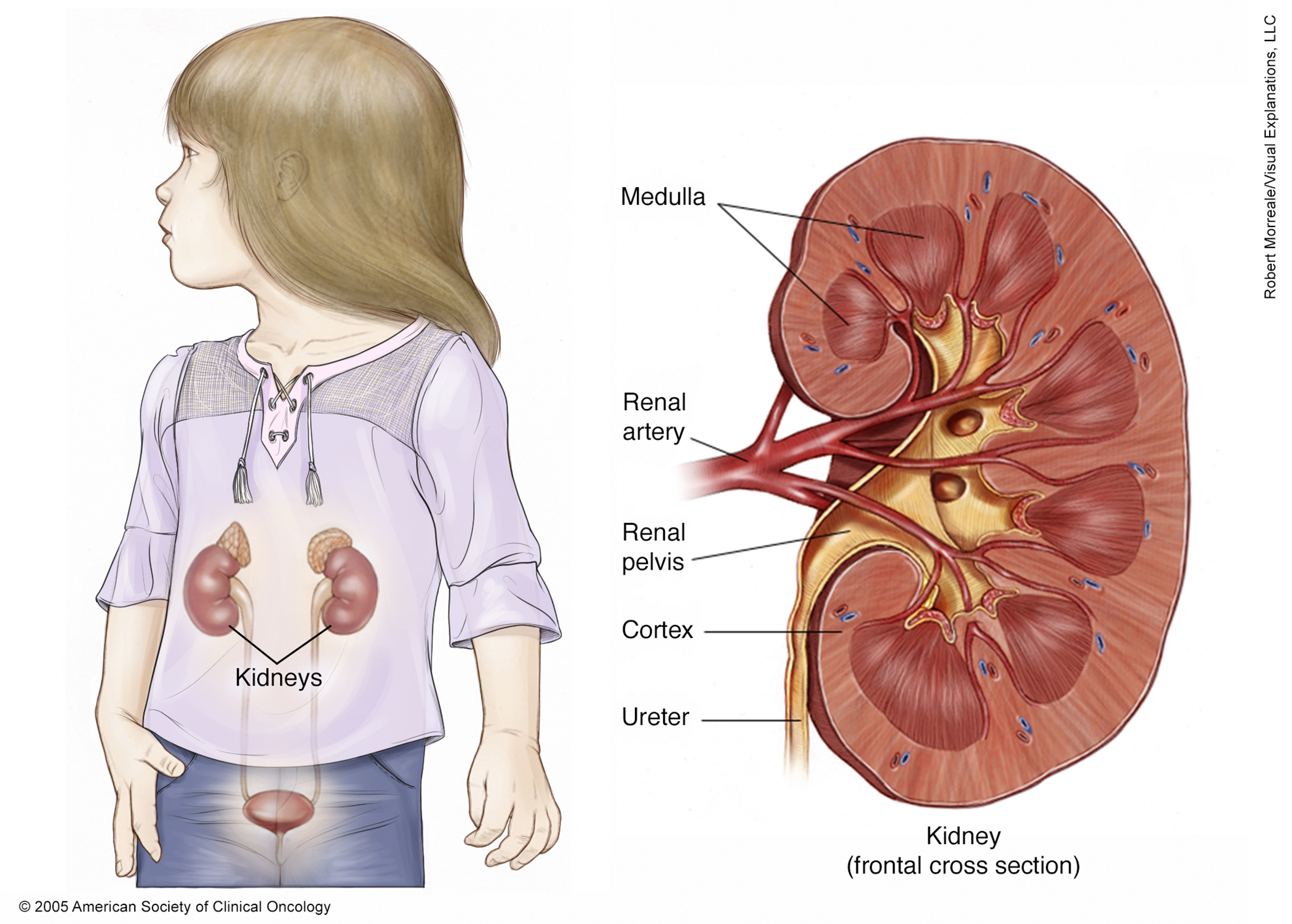 Illustration of the kidney of a child. See description for more information.