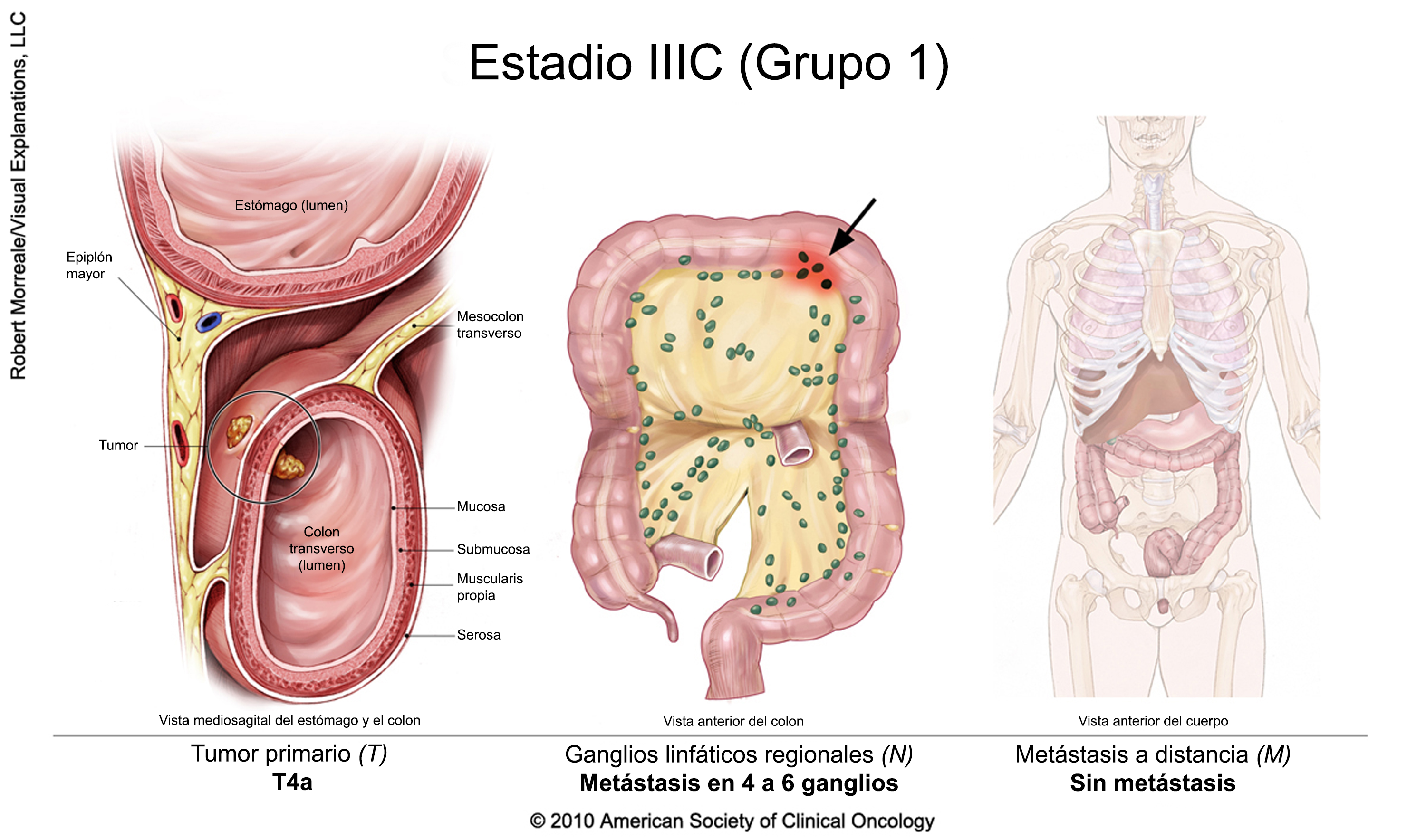 Adenocarcinom intestinal g2