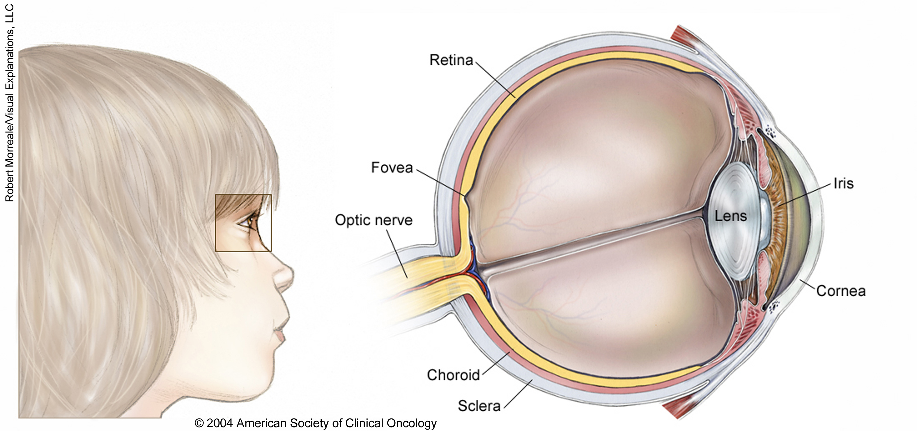 Illustration of the eye of a child. See description for more information.