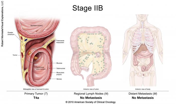 stage IIB colorectal cancer