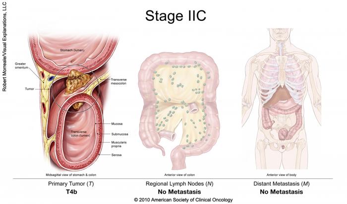 Cancer colorectal de stade IIC