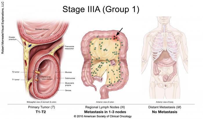 stage IIIA colorectal cancer (group 1)