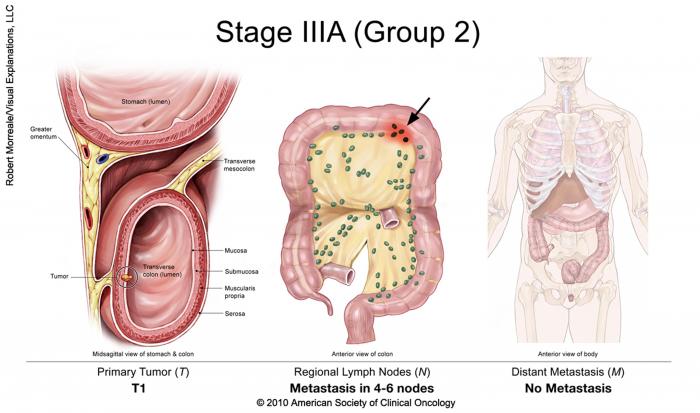 stage IIIA colorectal cancer (group 2)
