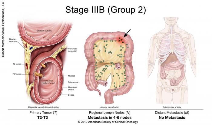 Cancer colorectal de stade IIIB (groupe 2)
