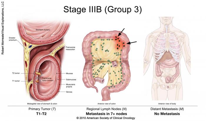 มะเร็งลำไส้ใหญ่ระยะที่ IIIB (กลุ่มที่ 3)