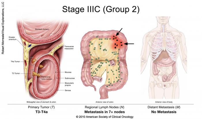 Cancer colorectal de stade IIIC, groupe 2