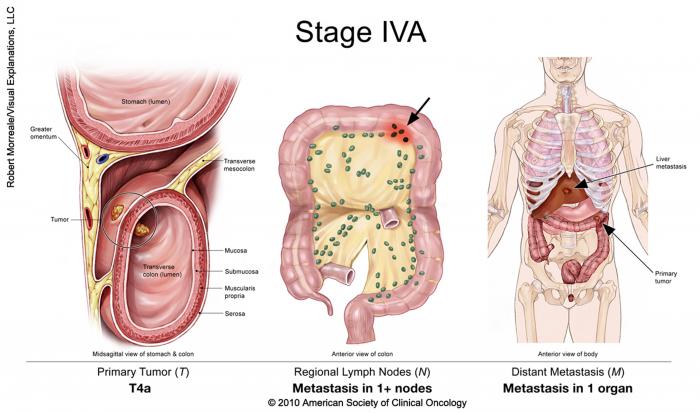 Cancer colorectal de stade IVA
