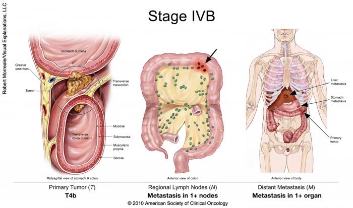 Cancer colorectal de stade IVB