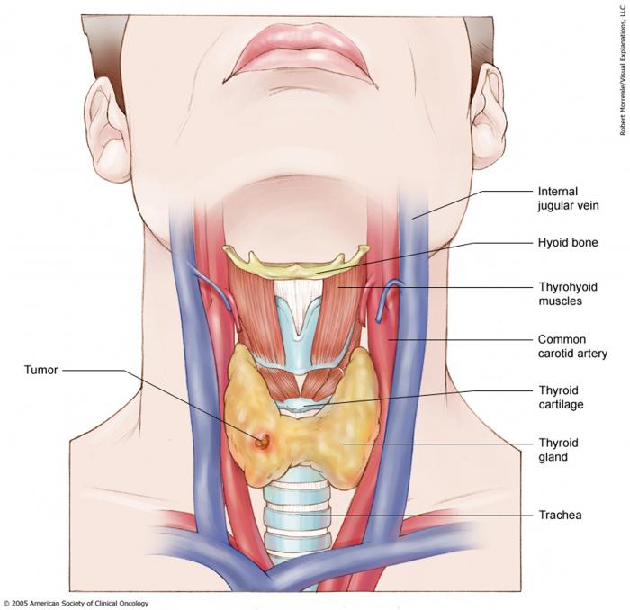 Stage I Thyroid Cancer