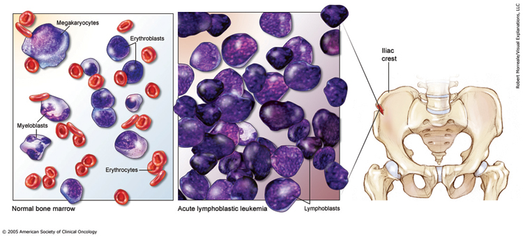 Leukemia - Acute Lymphoblastic - ALL - Childhood: Medical Illustrations | Cancer.Net